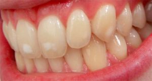 Mild Dental Fluorosis